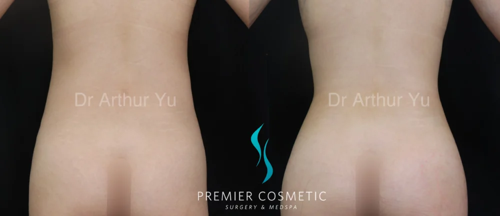 Hourglass Sculpting case #19093