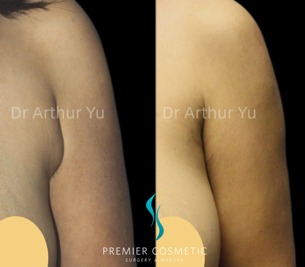 Accessory Breast Removal case #19113