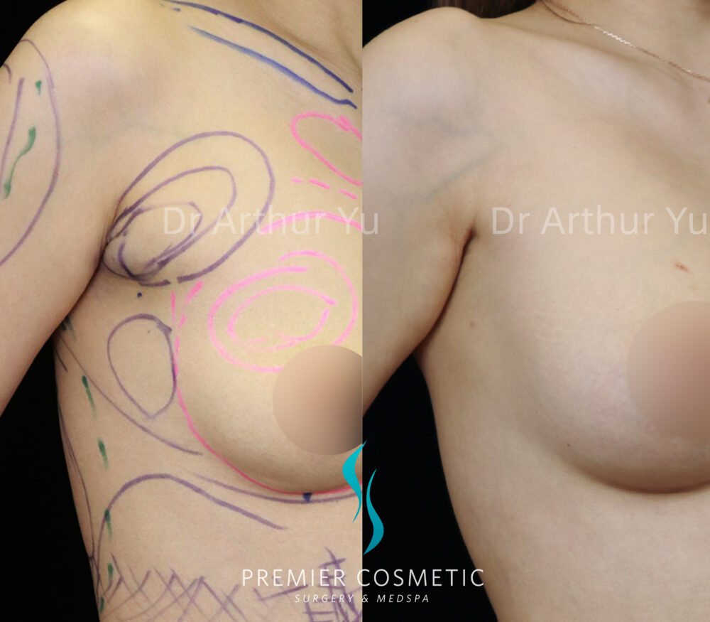 Accessory Breast Removal case #19121