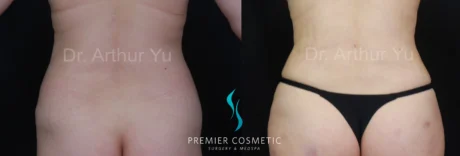 Hourglass Sculpting case #19101