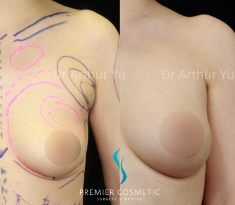 Accessory Breast Removal case #19119