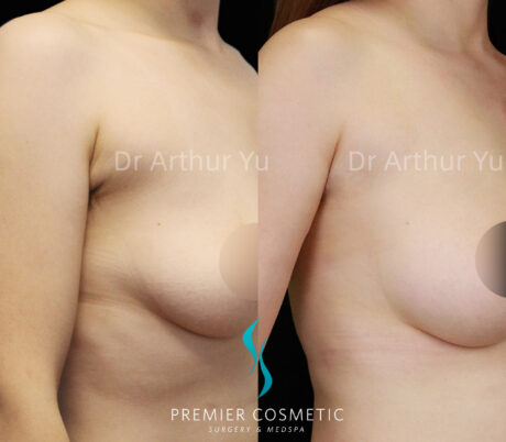 Accessory Breast Removal case #19117