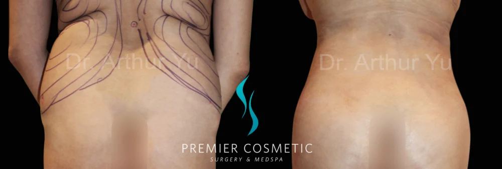 Hourglass Sculpting case #19099