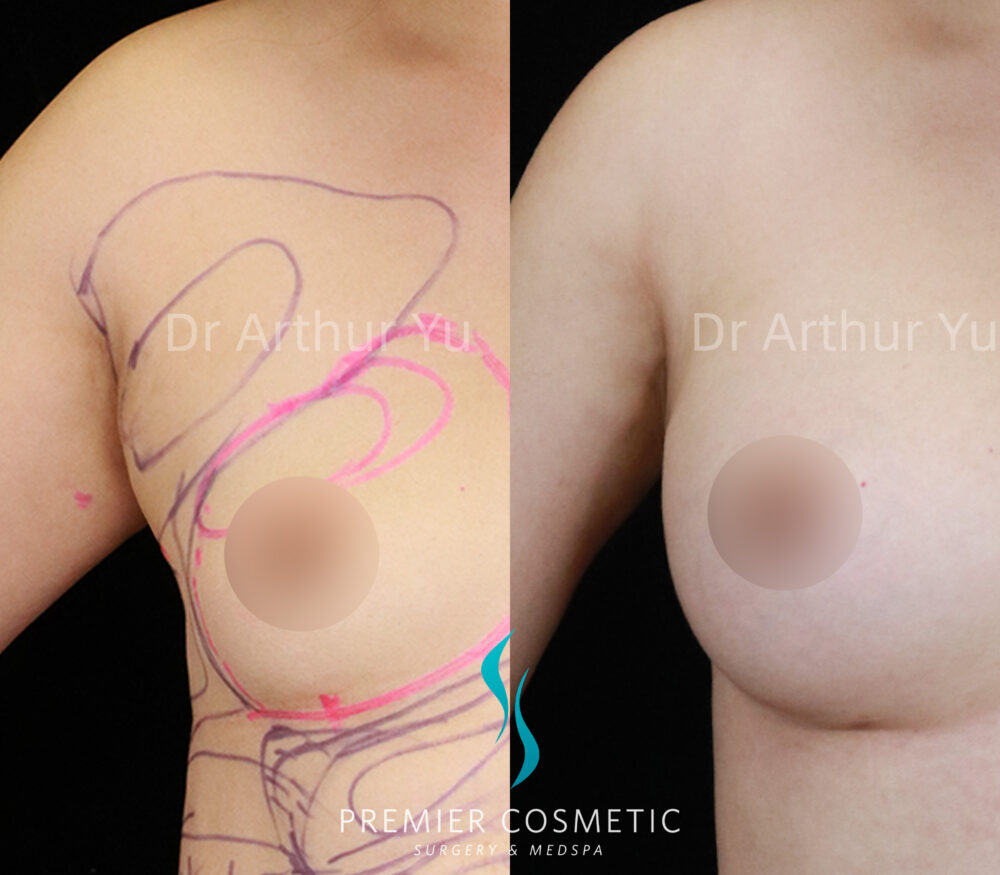 Accessory Breast Removal case #19115