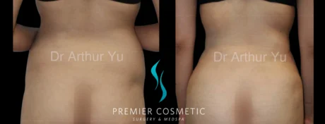 Hourglass Sculpting case #19109