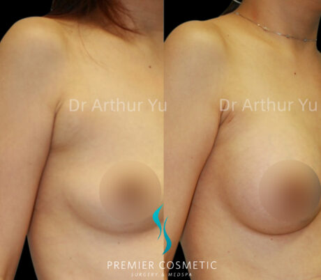 Accessory Breast Removal case #19139