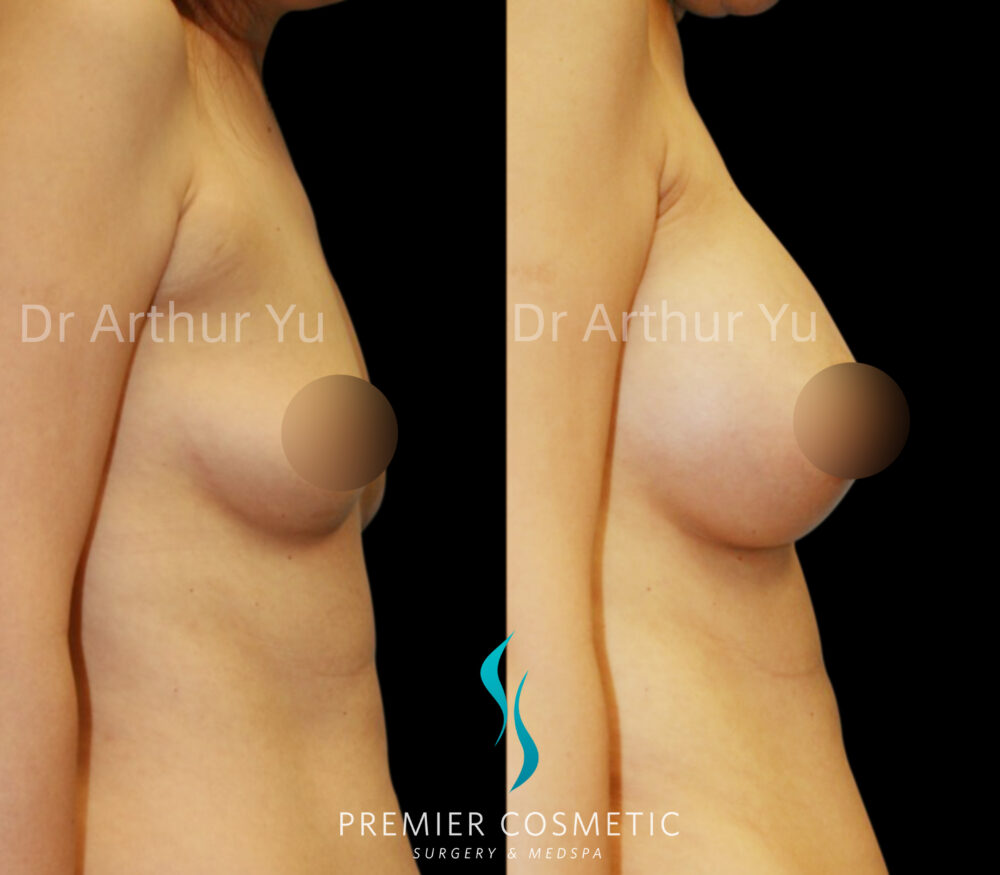 Accessory Breast Removal case #19137