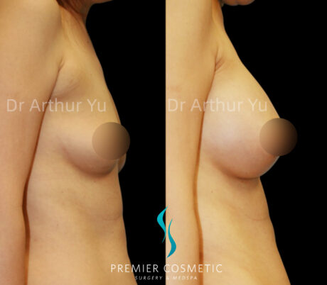 Accessory Breast Removal case #19137