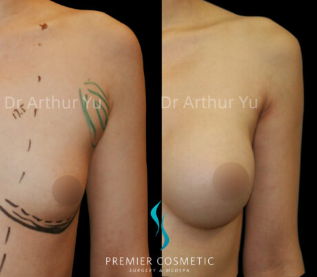 Accessory Breast Removal case #19135