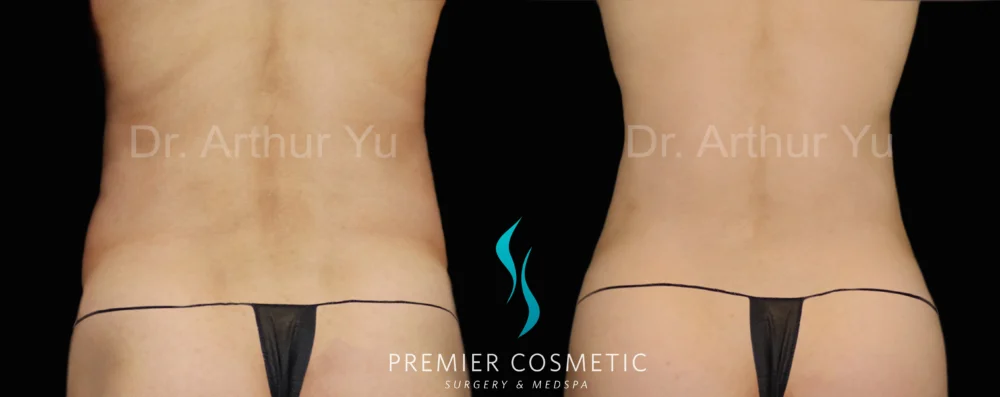 Hourglass Sculpting case #19097