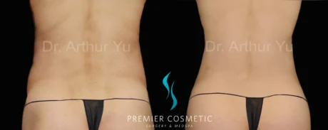 Hourglass Sculpting case #19097