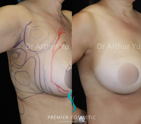 Accessory Breast Removal case #19133
