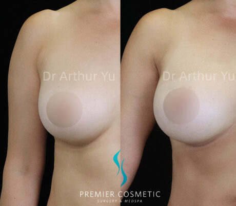 Accessory Breast Removal case #19131