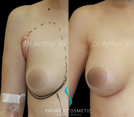 Accessory Breast Removal case #19129