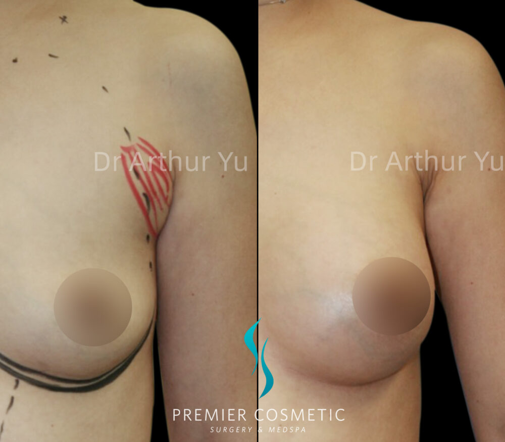 Accessory Breast Removal case #19127