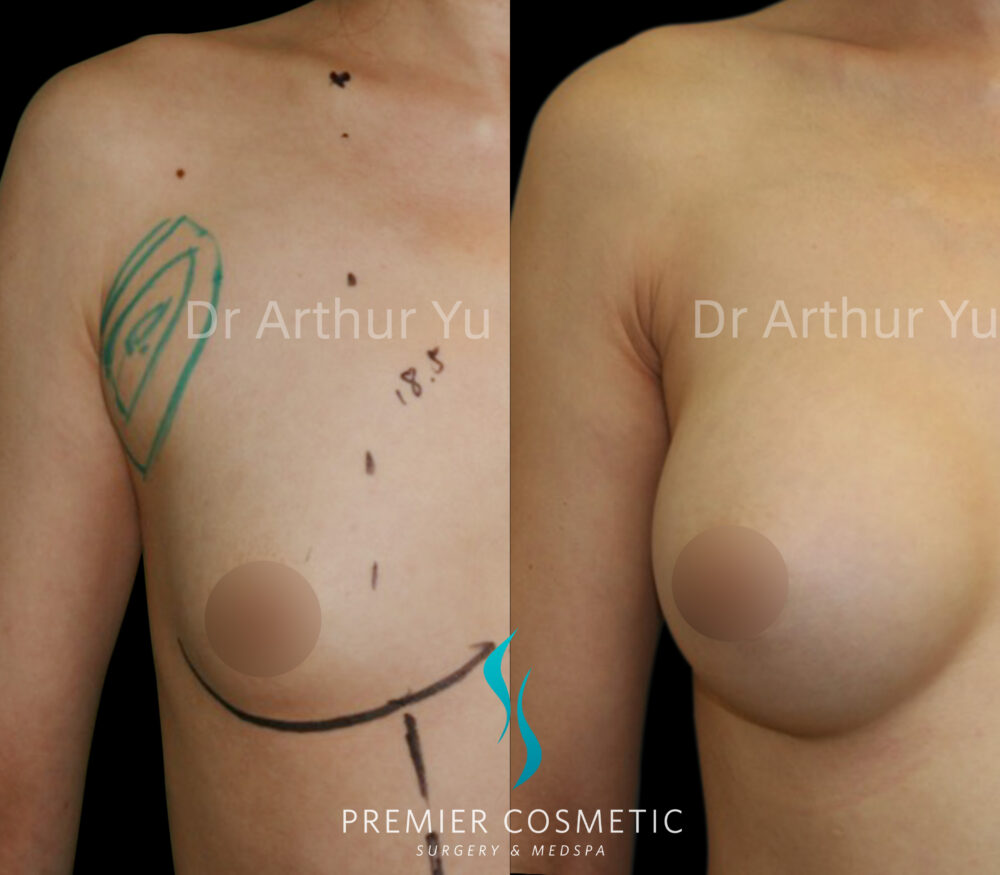Accessory Breast Removal case #19125