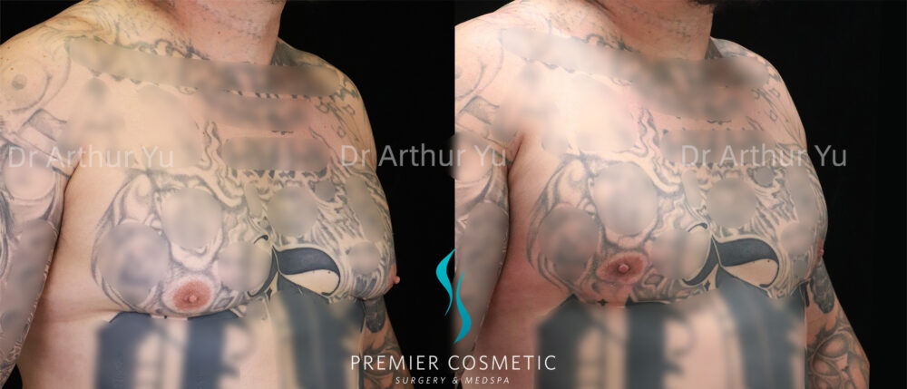 Gynecomastia case #19083
