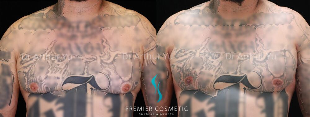Gynecomastia case #19085