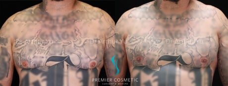 Gynecomastia case #19085