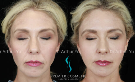 Sculptra case #19073