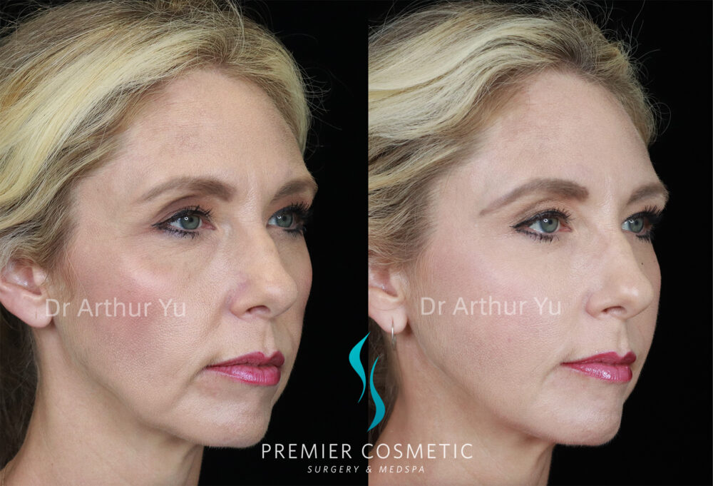 Sculptra case #19077