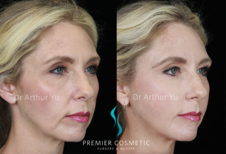 Sculptra case #19077