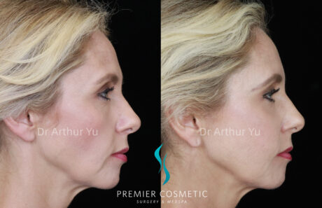 Sculptra case #19075