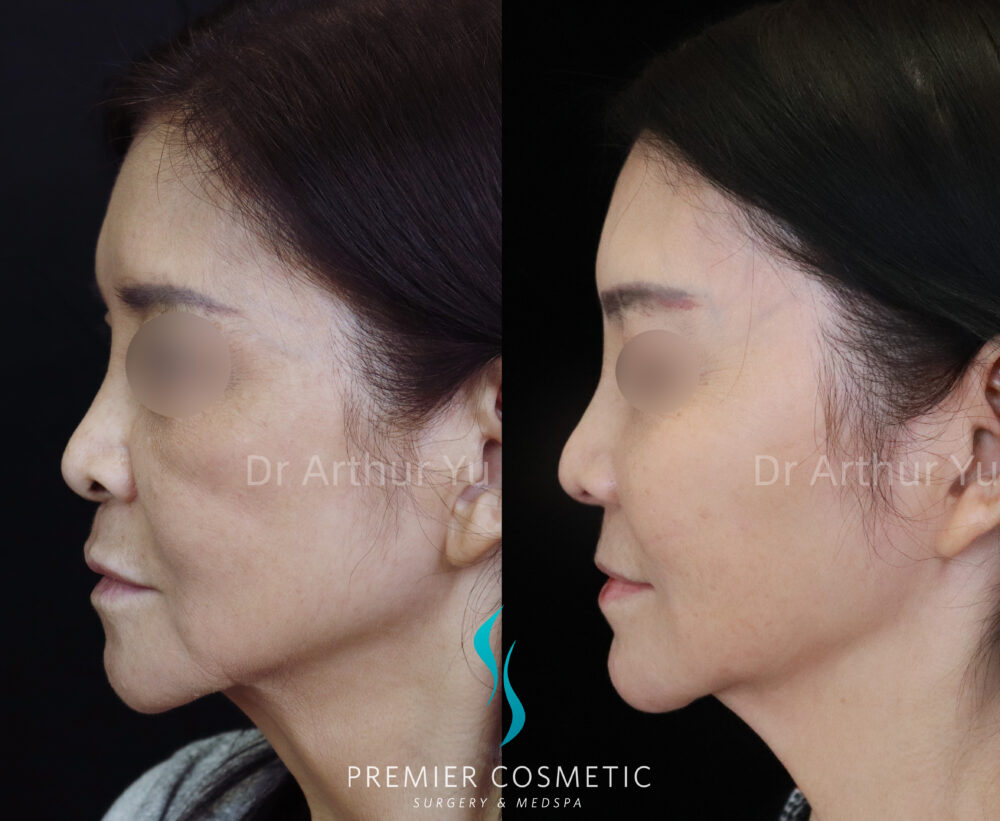Sculptra case #19081