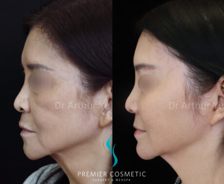 Sculptra case #19081