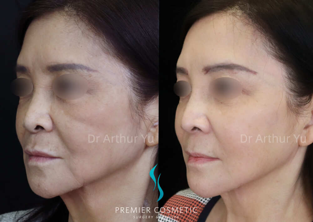 Sculptra case #19079