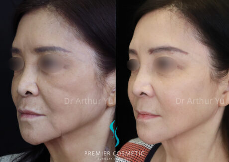 Sculptra case #19079