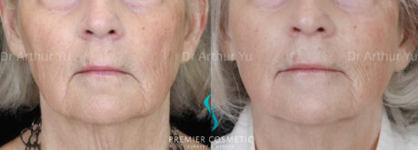 Sculptra case #19071